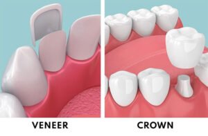 Dental Veneers and Crowns