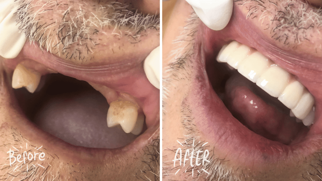 Dental Implant before and after by Angel Dental Care