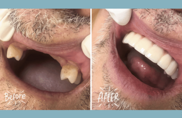 Angel Dental Care in El Monte Before and After photos