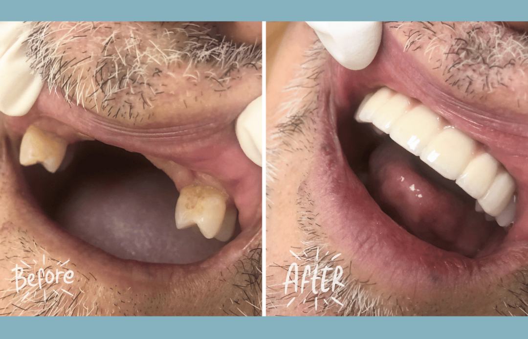 Dental Implants El Monte, Ca.