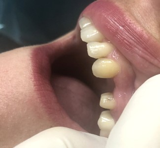 Dental Implant Before and After