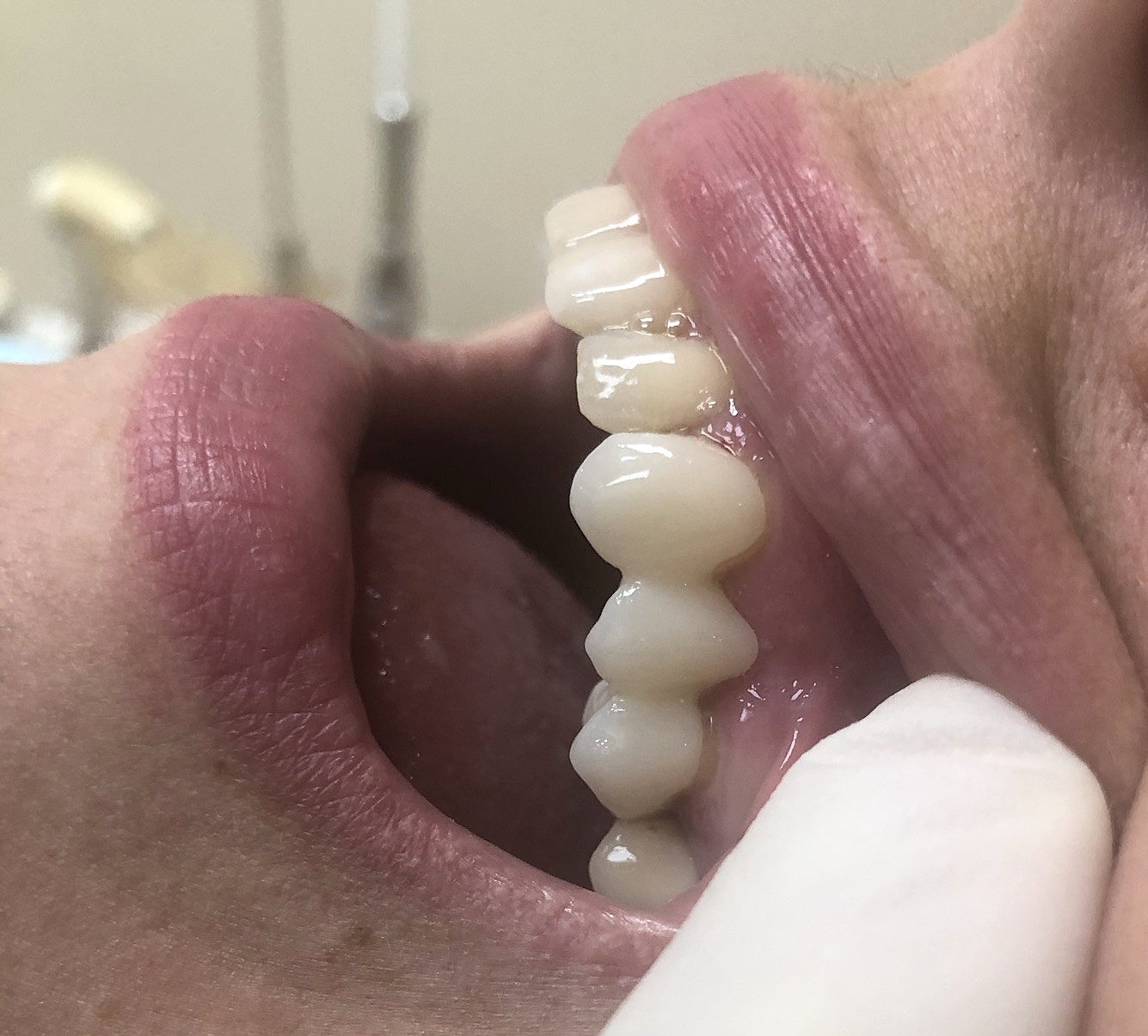 Dental Implant Before and After