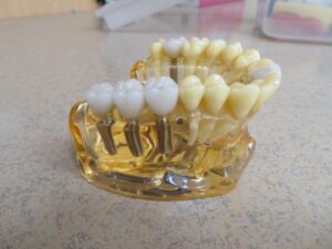 Dental Implants: What to Expect at Angel Dental Care in El Monte