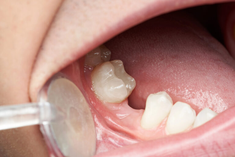 Can Missing Teeth Cause Bone Loss in Your Jaw?