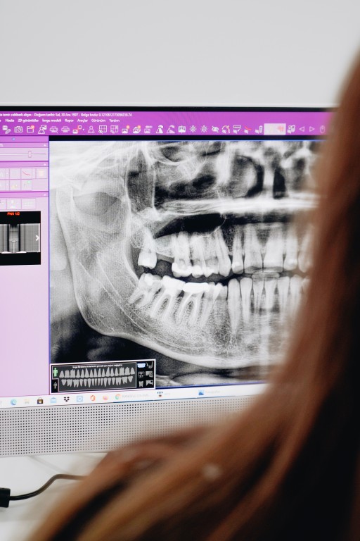 Bone Loss after losing a tooth