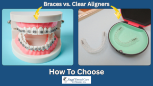 Clear Aligners or Braces? How to Choose the Right Treatment for Your Smile